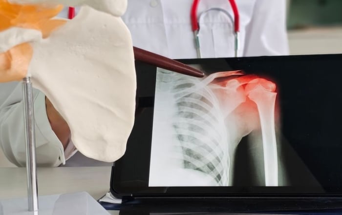 Rio-Orthopedic-Sports-Medicine-Collarbone-Surgery_-3-Signs-You-Need-Surgical-Repair-For-A-Clavicle-Fracture